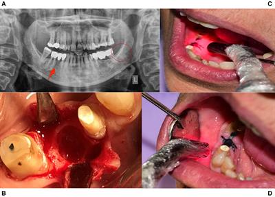 The combined use of photobiomodulation therapy and platelet-rich fibrin for the management of two MRONJ stage II cases: An alternative approach